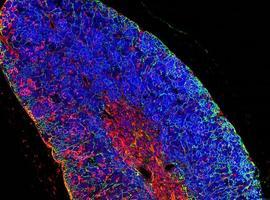 Generan por primera vez una leucemia humana de linfocitos T a partir de una célula sana