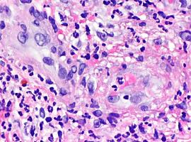 Estudio científico que identifica numerosos genes implicados en vasculitis