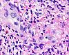 Estudio científico que identifica numerosos genes implicados en vasculitis