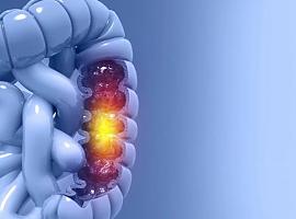 Cáncer de colon: juega tu papel para salvar vidas