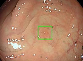 La Inteligencia Artificial se convierte en aliada clave para detectar precozmente el cáncer colorrectal en España