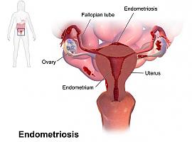 Asturias implanta un programa pionero para mejorar la atención a mujeres con endometriosis: diagnóstico más ágil y tratamiento personalizado en todo el sistema sanitario