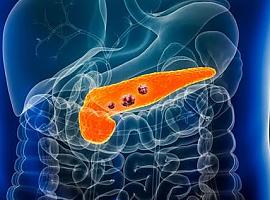 Descubren un nuevo factor clave que hace al cáncer de páncreas más agresivo: así actúa desde el corazón del tumor