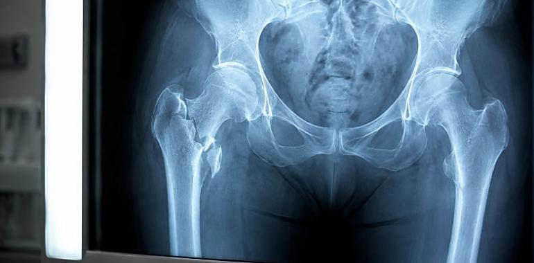 Casi dos meses con una cadera fracturada esperando una operación: el Consejo Consultivo avala indemnizar a una mujer de 95 años