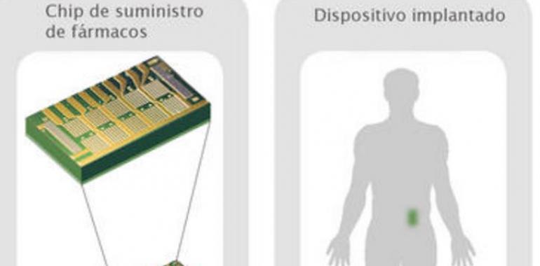 Chip implantado para dispensar fármacos contra la osteoporosis por control remoto