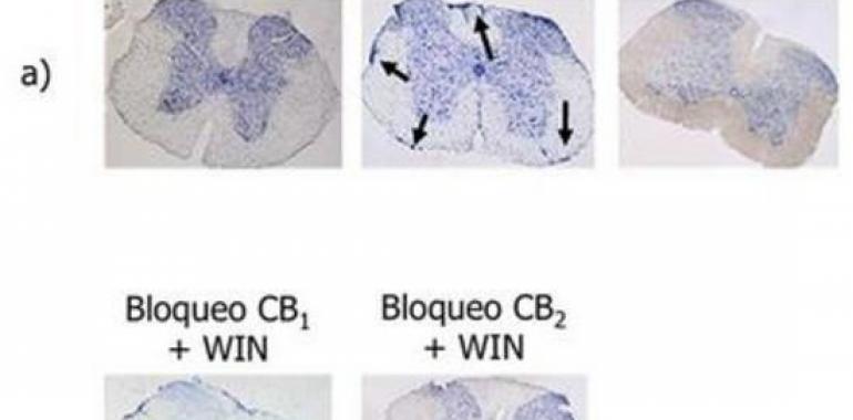 El cannabis disminuye la progresión de la esclerosis múltiple