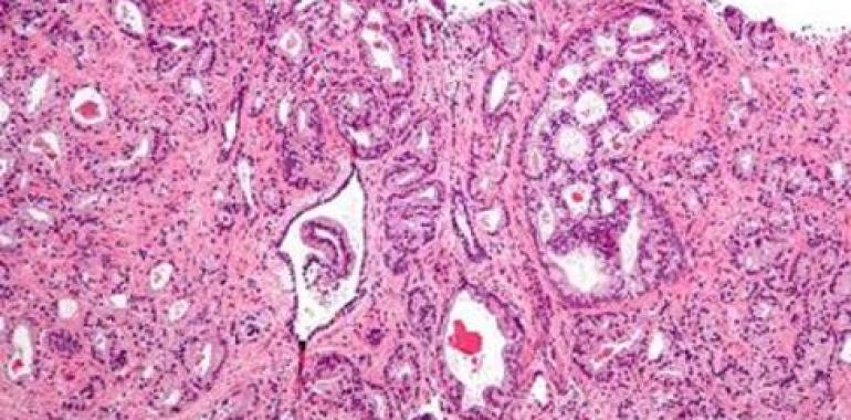 Investigadores españoles identifican un mecanismo para atacar las células madre del cáncer de próstata