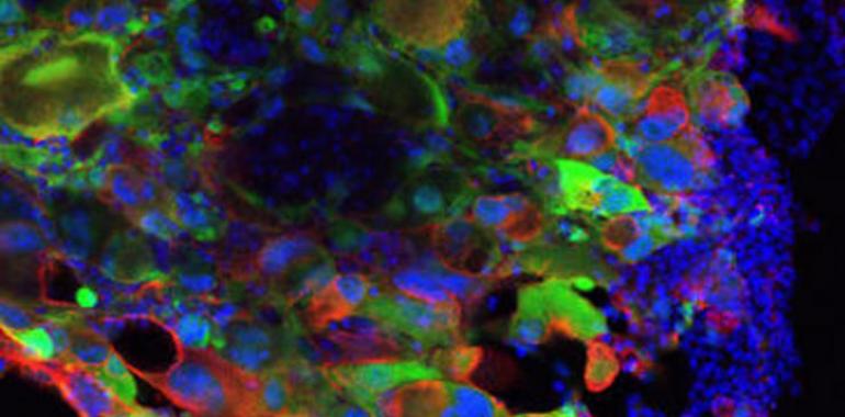 Células neuronales maduras se ‘resetean’ para originar un tumor cerebral