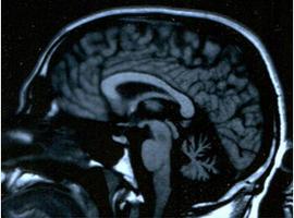La ataxia, un proceso degenerativo, afecta a unos 8.000 españoles