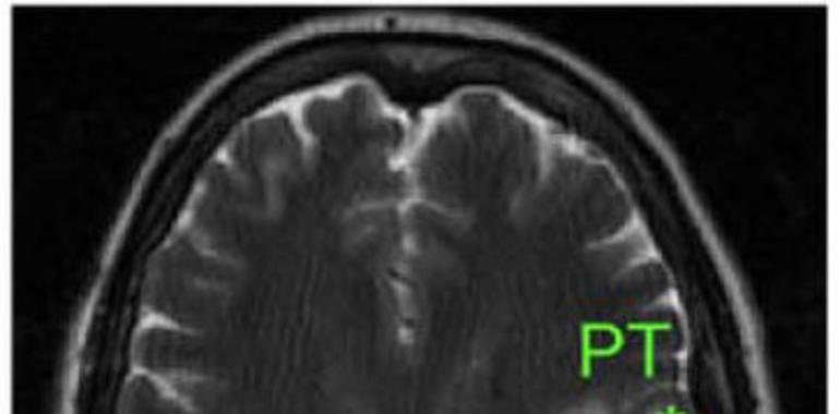 Identificados dos tipos de células iniciadoras de los tumores cerebrales más agresivos