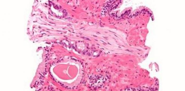 Encuentran el primer factor genético para el pronóstico del cáncer de próstata 
