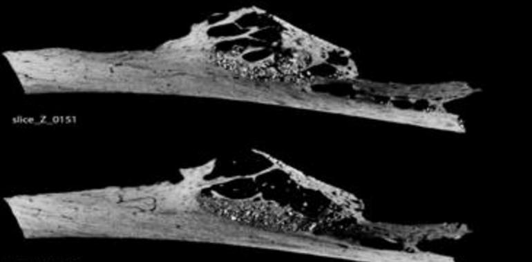 La enfermedad neoplásica del hermano Neandertal