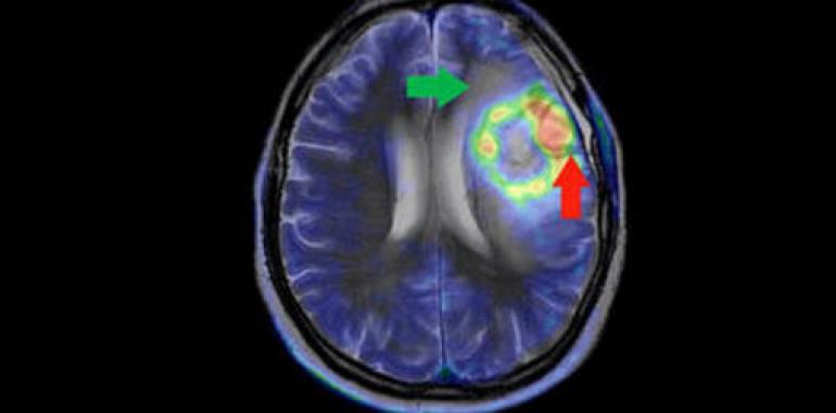 Un algoritmo delimita automáticamente tumores cerebrales en imágenes médicas