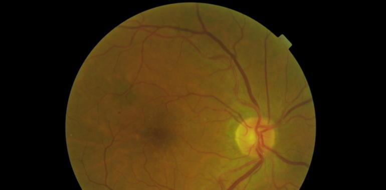 Teleoftalmología para prevenir la retinopatía diabética