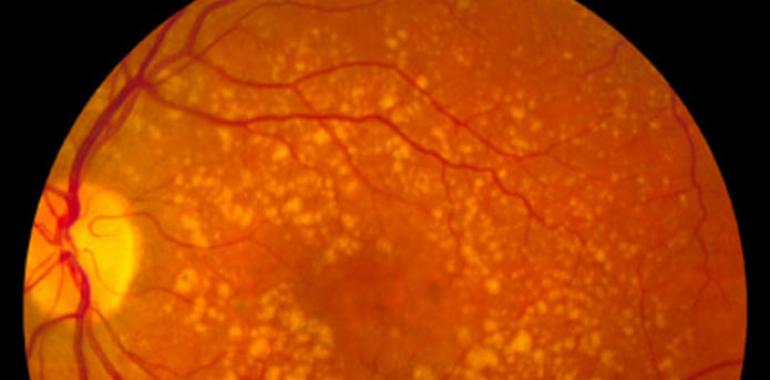 Nuevas investigaciones en torno al #edema #macular #diabético