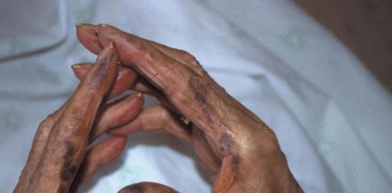Buscan tratamiento para la enfermedad de los huesos negros 