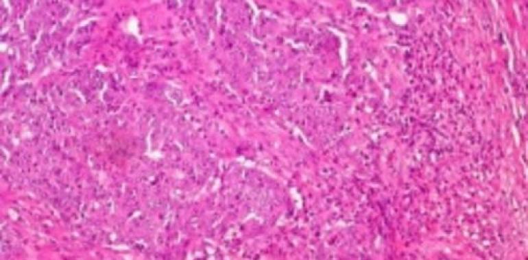 Una inmunotoxina eficaz contra las células tumorales del colon