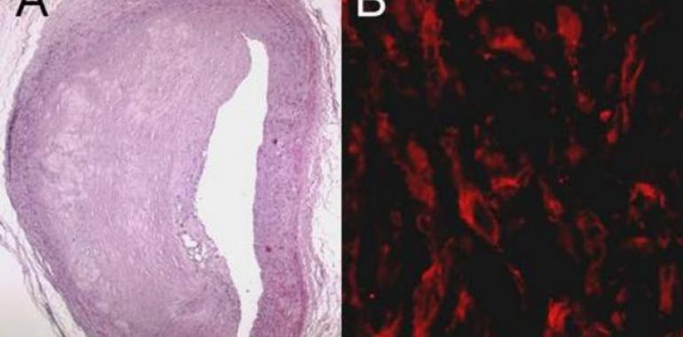 Investigadores españoles descubren una molécula que provoca arteriosclerosis