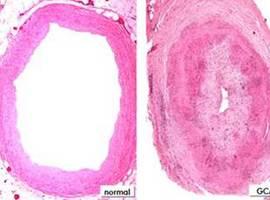 Identificados dos genes de riesgo para padecer arteritis de células gigantes