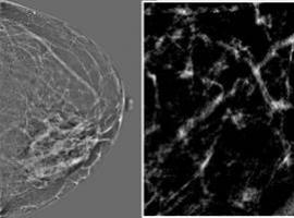 Nuevo sistema de ayuda al diagnóstico del cáncer de mama basado en inteligencia artificial