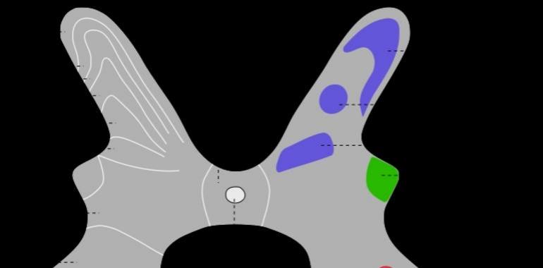 Avanzan en el tratamiento del dolor neuropático